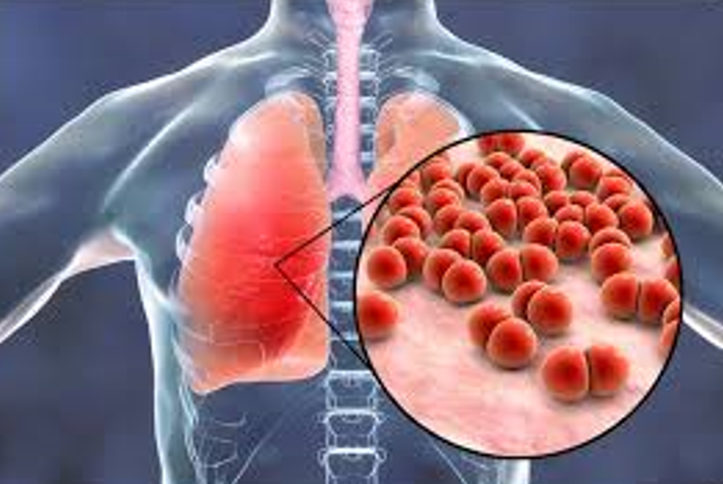 Management of Pneumonia 